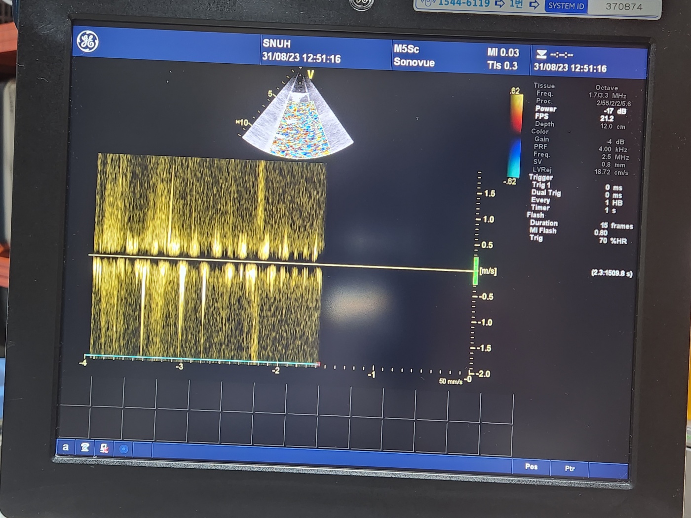 GE Vivid E9 XDClear Ultrasound System