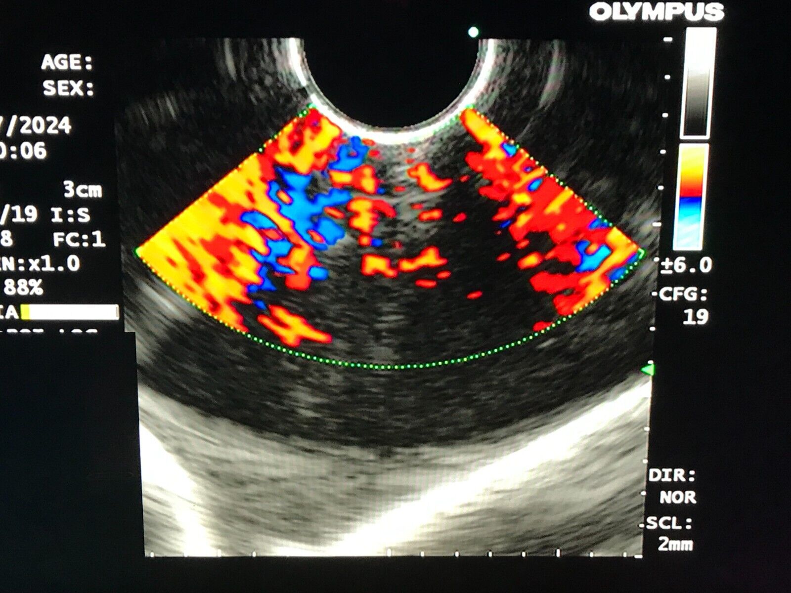 OLYMPUS GF-UCT260 Linear Echoendoscope