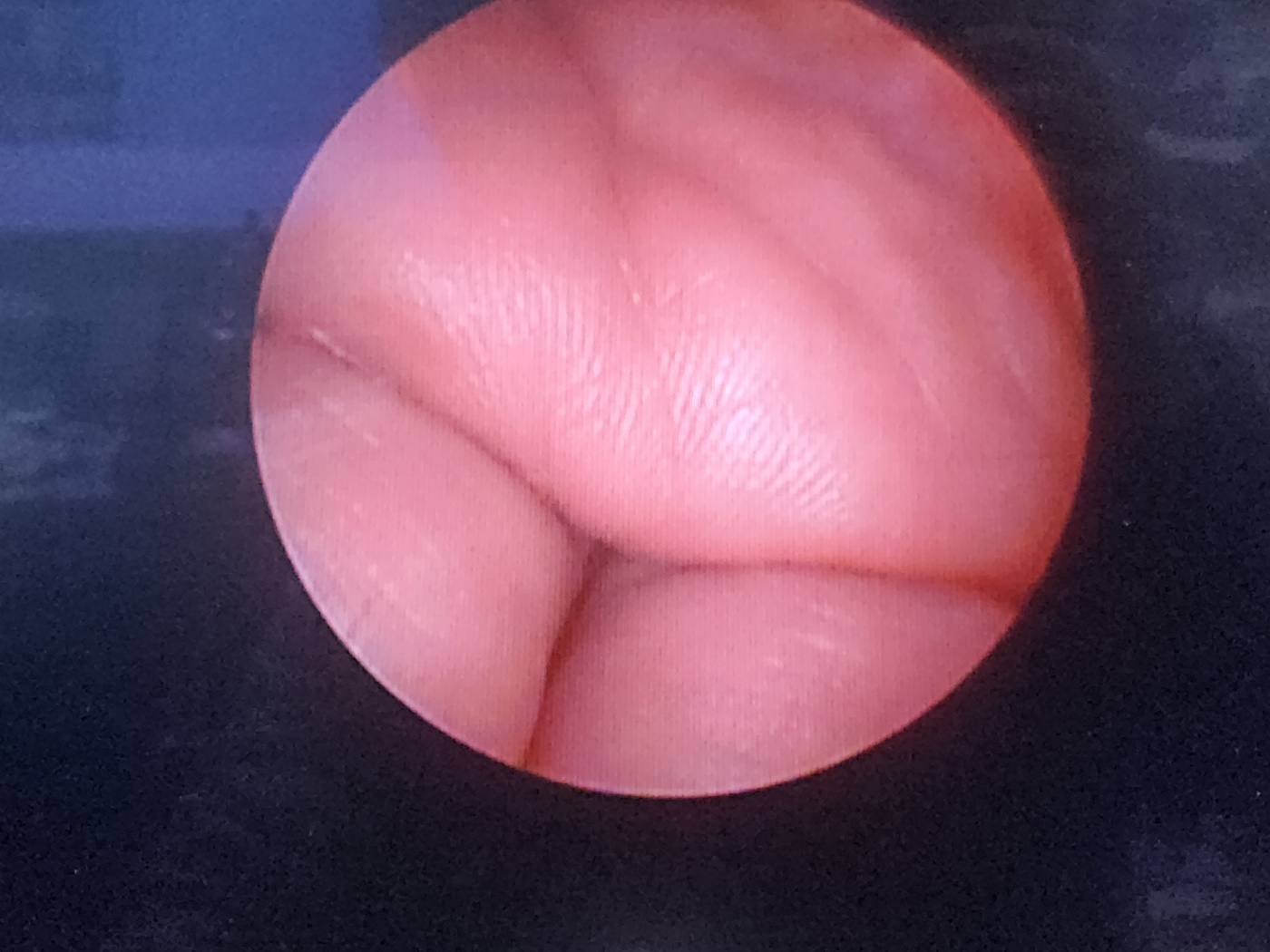 Karl Storz Hopkins Telescope