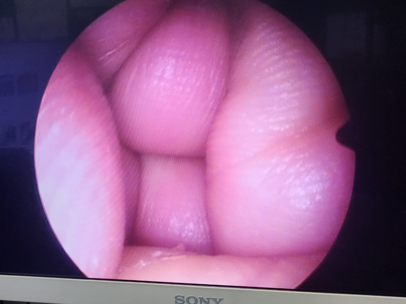 SCHÖLLY Hysteroscopes