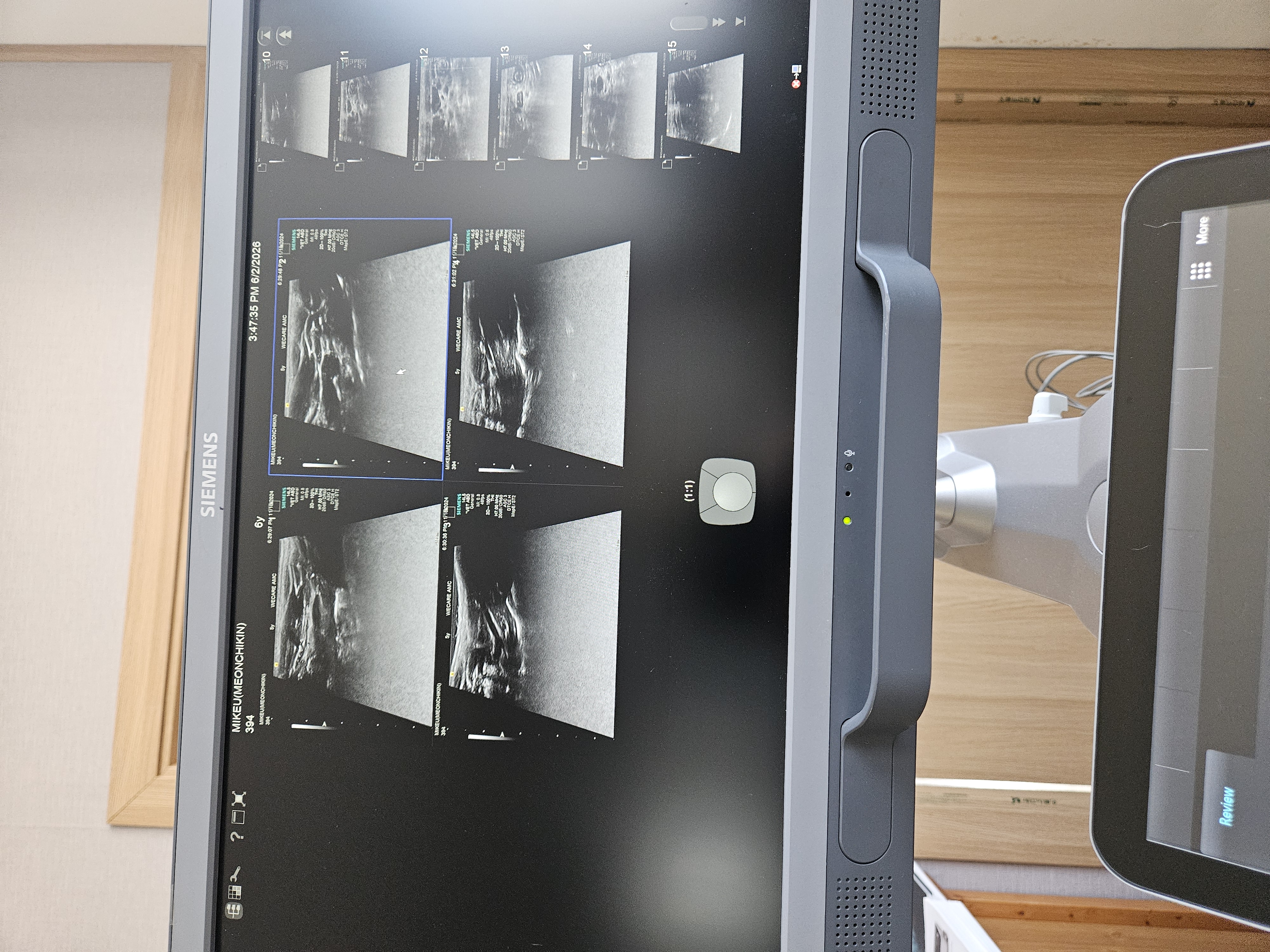 ACUSON S1000 Diagnostic Ultrasound System